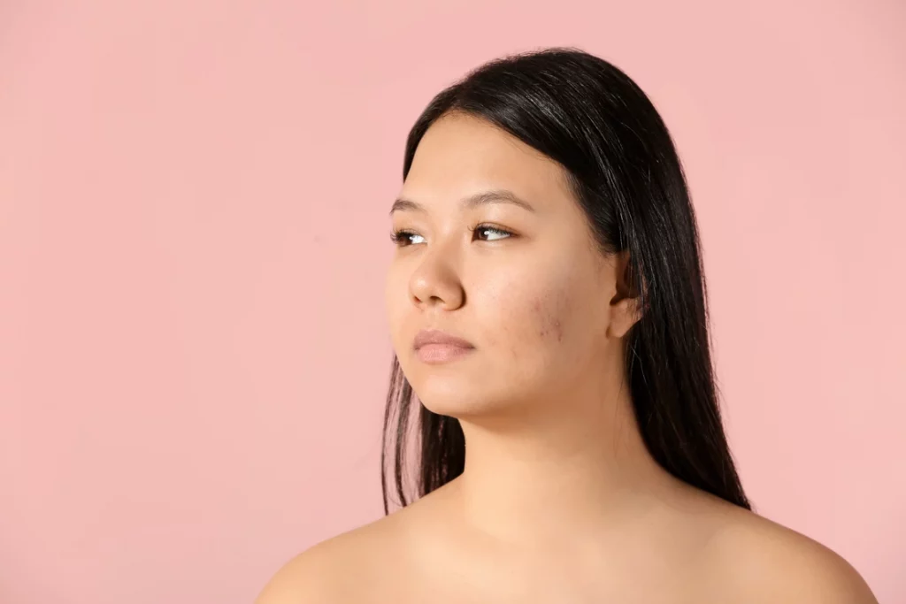 woman-suffering-from-hyperpigmentation